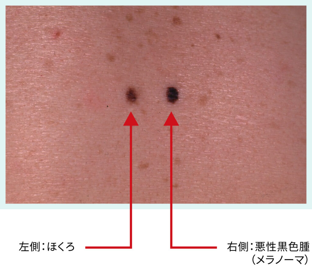 左側:ほくろ 右側:悪性黒色腫(メラノーマ)
